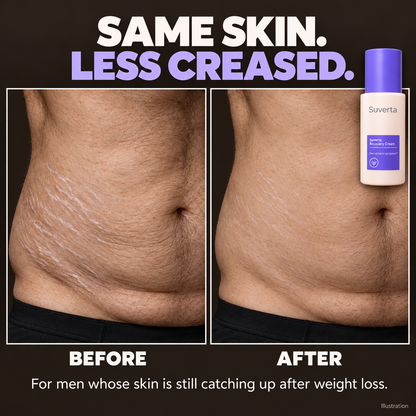 Suverta Recovery Cream – Stretch Mark & Crepey Skin Care