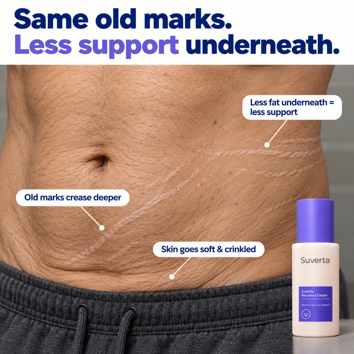 Suverta Recovery Cream – Stretch Mark & Crepey Skin Care